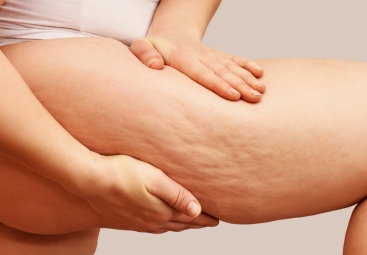 Lipoedema vs. Cellulite: Key Differences & Diagnostic Tips.